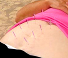 patient receiving acupunture